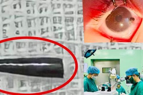 Phẫu thuật cấp cứu bé trai 9 tháng tuổi bị ruột bút chì xuyên thủng nhãn cầu