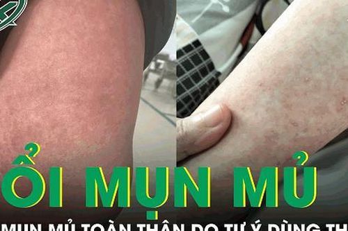 Bệnh nhi 13 tuổi nổi mụn mủ toàn thân vì tự uống thuốc long đờm