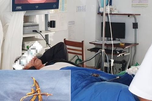 Dùng cành cà phê khô gãi niệu đạo, bệnh nhân phải nhập viện với dị vật dài 10cm