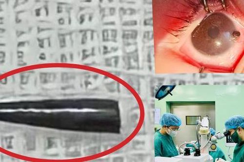 Bé 9 tháng tuổi bị ruột bút chì đâm thủng nhãn cầu