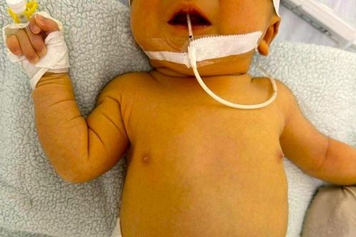 Căn bệnh khiến em bé phải thay máu khi vừa sinh 3 ngày