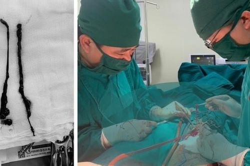 Đau chân, đi khám phát hiện tắc động mạch chậu đùi cấp