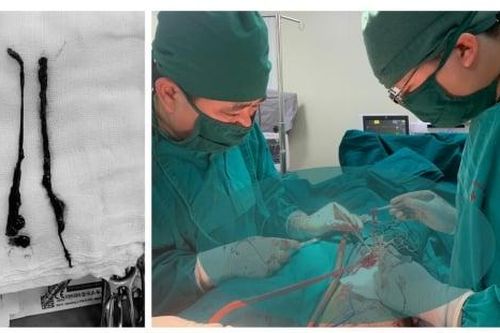 Đau chân trái đột ngột, suýt phải cắt bỏ do tắc động mạch cấp