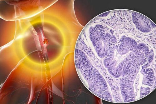 Những dấu hiệu giúp bạn nhận biết sớm ung thư thực quản