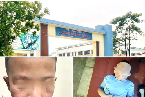 Học sinh Trường Tiểu học Hải Bối bị dị ứng vì thuốc diệt muỗi: Phụ huynh bức xúc, Hiệu trưởng nói gì?