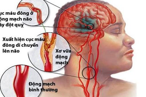 8 nhóm người có nguy cơ đột quỵ cao, đặc biệt nam giới có 2 thói quen này cần cảnh giác