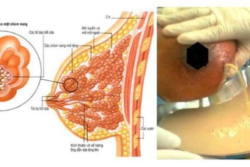 Các biện pháp điều trị áp xe vú