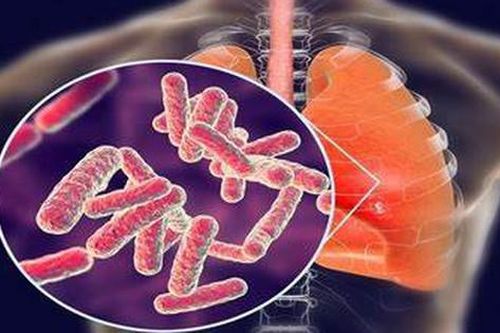 5 bước đơn giản giúp ngăn chặn bệnh lao