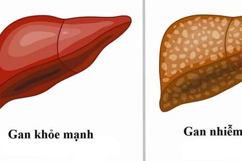 Gan nhiễm mỡ: Nguyên nhân, biểu hiện, điều trị và phòng bệnh