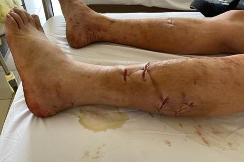 Bị khỉ cắn, hai vợ chồng nhập viện