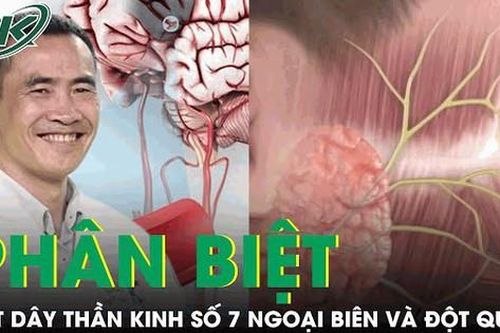 Cách phân biệt liệt dây thần kinh số 7 ngoại biên và đột quỵ