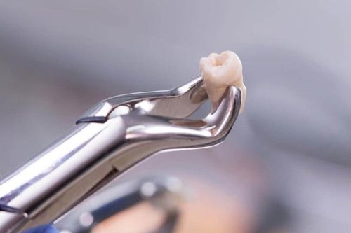 Thận trọng nếu muốn nhổ răng ở vị trí này