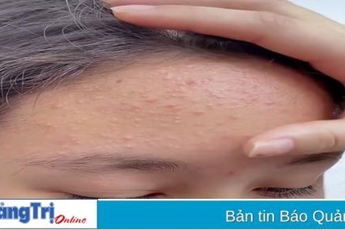 Trị mụn như thế nào cho hiệu quả?