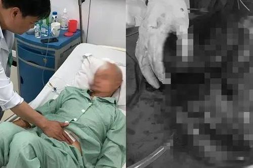 Người đàn ông hoại tử ruột non nghi ngộ độc thức ăn