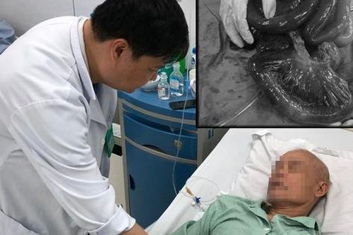 Hoại tử gần toàn bộ ruột nghi do ngộ độc thức ăn