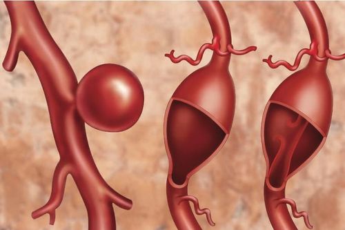 Phình động mạch chủ: Nguyên nhân, triệu chứng, điều trị và cách phòng ngừa