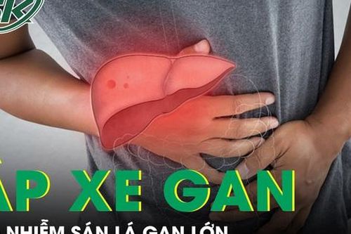 Người đàn ông phát hiện ổ áp xe gan do nhiễm sán lá gan lớn