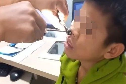 Gắp ký sinh trùng dài 8 cm trong mũi thiếu niên