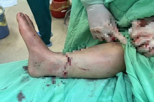 Nối thành công đoạn chân đứt rời cho bệnh nhân tai nạn giao thông