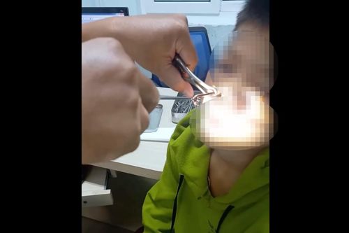 Gắp con vắt dài 8cm sống trong mũi thiếu niên