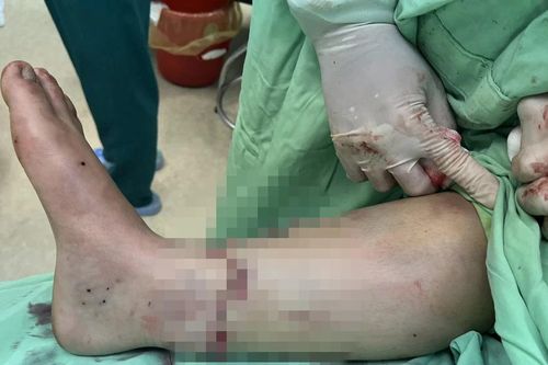 Đắk Lắk: Phẫu thuật nối liền bàn chân bị đứt rời cho người bị tai nạn giao thông