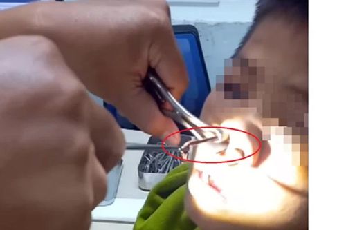 Kon Tum: Gắp thành công con vắt dài 8cm trong mũi một thiếu niên