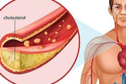 Tại sao thanh niên từ 20 tuổi trở lên nên kiểm tra cholesterol 5 năm/ lần?