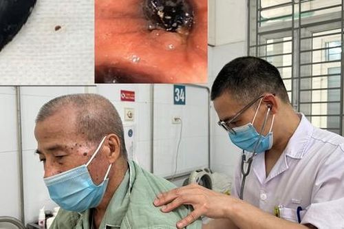 Ho 3 tháng đi khám phát hiện hạt hồng xiêm trong phế quản
