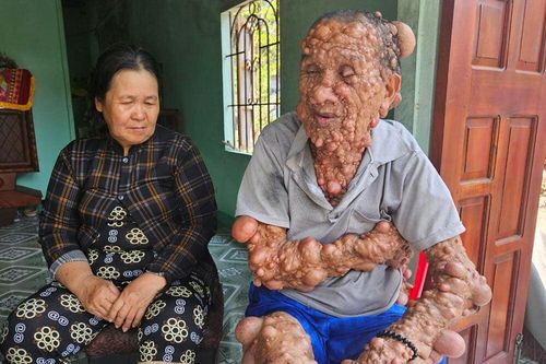 Người phụ nữ nghèo bất lực nhìn chồng con đau đớn vì khối u chiếm toàn bộ cơ thể