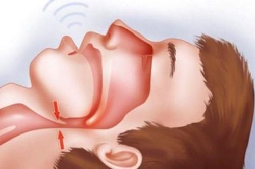 Câu hỏi thường gặp liên quan đến ngừng thở khi ngủ