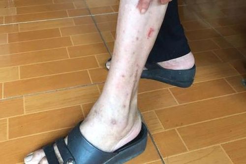 Nguyên nhân khiến hàng chục người ở Thanh Hóa nổi ngứa toàn thân