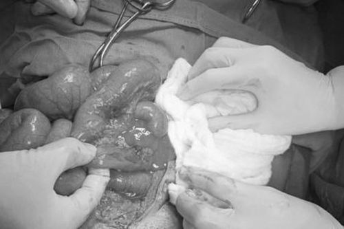 Bác sĩ 'chạy đua' với thời gian cứu người đàn ông vỡ ruột non
