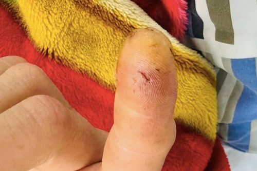 Nhập viện sau khi bị loài vật lông vàng, vẻ ngoài hiền lành cắn