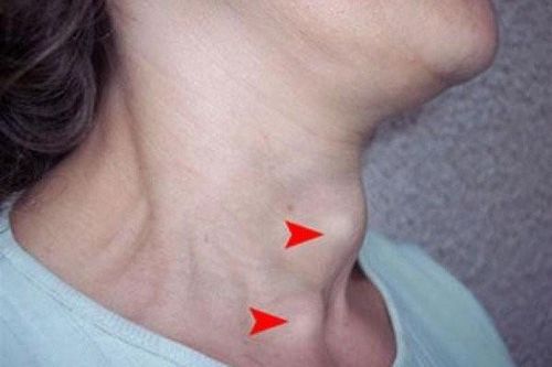 Khuyến cáo đề phòng biến chứng nguy hiểm do bệnh tuyến giáp