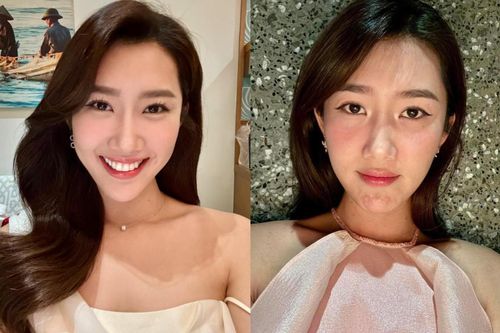 Nghi vấn Thúy Ngân gặp biến chứng sau khi 'trùng tu' nhan sắc. chi tiết lộ rõ trên mặt?