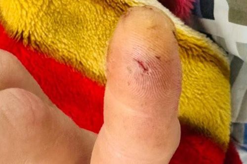 Mẩn ngứa, tê bì toàn thân sau khi bị cu li cắn