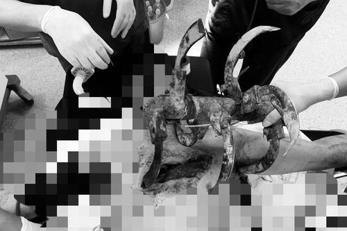Người đàn ông nhập viện với lưỡi cày cắm sâu vào ngực