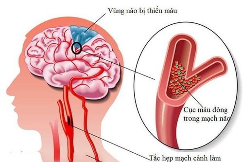 Dấu hiệu của thiếu máu não, đừng chủ quan đột quỵ như chơi