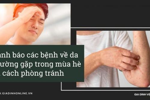 Cảnh báo bệnh về da thường gặp trong mùa hè và cách phòng tránh