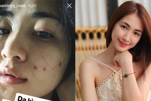 Hòa Minzy sạch mụn nhờ loại rau được người Nhật ví như 'rau giải độc', bán đầy ở chợ Việt