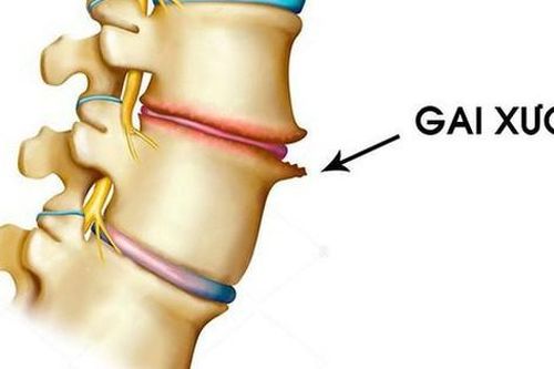Bài thuốc điều trị gai đốt sống cổ