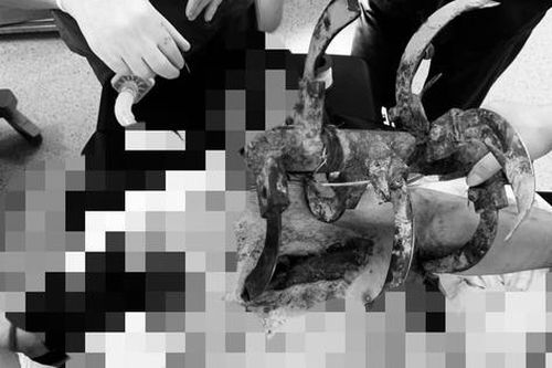 Tai nạn kinh hoàng, người nông dân nhập viện với lưỡi cày cắm sâu vào ngực