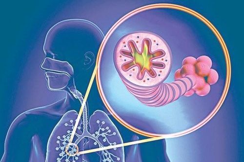 Thuyên tắc động mạch phổi, 'sát thủ' ẩn mình nên cẩn trọng