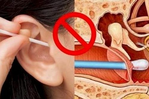 Lấy ráy tai không đúng cách nguy hiểm như thế nào?