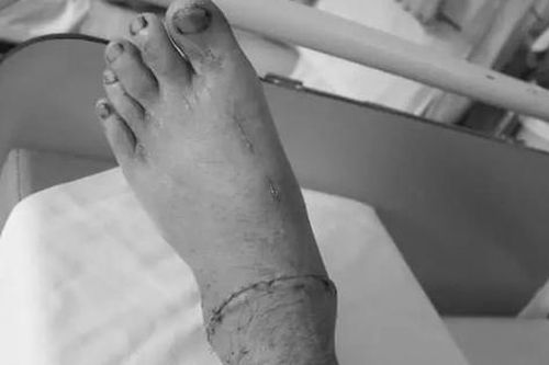 Nối lại bàn chân gần đứt rời cho người đàn ông bị máy cắt cỏ chém