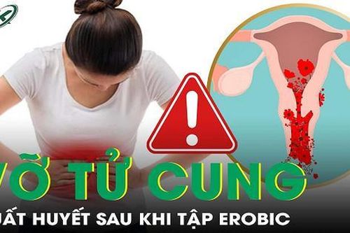 Sau tập Erobic cô gái 26 tuổi bị vỡ nang buồng trứng