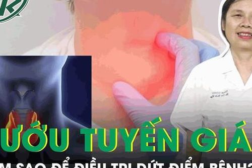 Làm sao để điều trị dứt điểm bệnh bướu tuyến giáp?