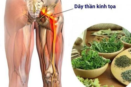 Bài thuốc trị đau thần kinh tọa do nhiều nguyên nhân