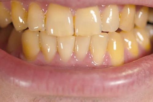 Răng ố vàng có phải là bệnh?