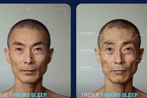 Giật mình với những thay đổi diện mạo khi bạn ngủ không đủ 7 giờ mỗi đêm
